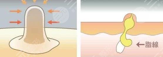 眼睛周圍長脂肪粒怎么辦?