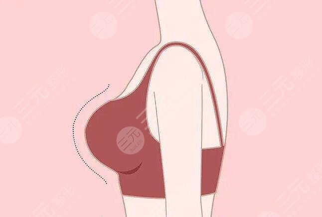 假體隆胸的材料什么牌子好?假體品牌各優(yōu)勢缺點詳細介紹~來選你喜歡的吧~