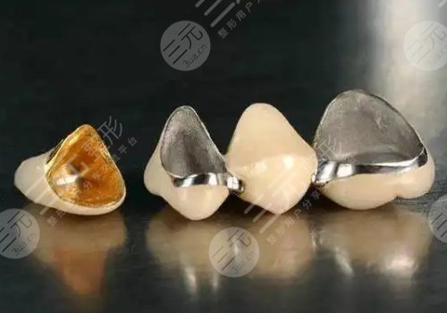 滿口烤瓷牙要多少錢?