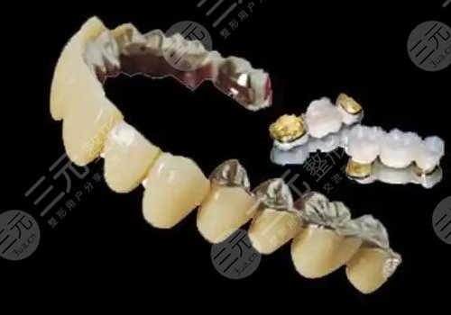 滿口烤瓷牙要多少錢?