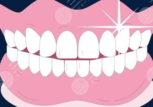 冷光美白牙齒多少錢?