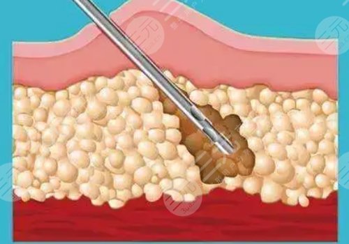 成都高新怡脂醫(yī)療美容怎么樣?
