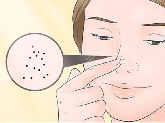 蘇打水去黑頭的注意事項(xiàng)