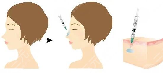 玻尿酸隆鼻手術(shù)的案例