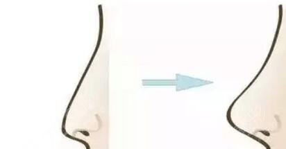 玻尿酸隆鼻手術(shù)的案例