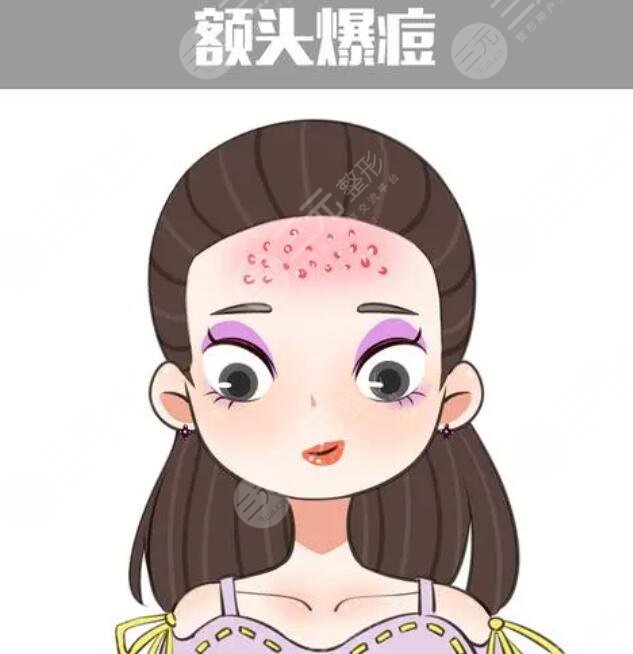 　　額頭上長痘痘的原因是什么呢?長痘痘是很多朋友的心頭大患，因?yàn)樵谶M(jìn)入青春期之后，很多朋友臉上都會(huì)或多或少的長出痘痘，痘痘又紅又腫，有的時(shí)候還有很多分泌物，一碰就很疼，這給大家?guī)砹撕芏嗟臒?。而有一部分朋友即便是走出了青春期，臉上仍舊有很多的痘痘存在。尤其是額頭上的痘痘特別的嚴(yán)重。實(shí)際上不同的部位痘痘生長都是有原因的，下面就針對額頭上的痘痘，我們進(jìn)行深入的分析。  　　1、額頭上長痘痘的原因是什么?  　　痘痘又被大家稱作為痤瘡或者青春痘。一般在額頭上，臉上，胸部背部長得比較多。因?yàn)檫@些部位皮膚角質(zhì)層比較薄，而且油脂分泌旺盛，給痘痘的生長提供了很好的條件。痘痘的生長是由于皮膚里面生產(chǎn)了大量的油脂，將毛孔堵塞。尤其是油脂栓塞了毛囊口加上周圍致痘細(xì)菌的影響，就形成了丘疹痘痘。這些痘痘一般呈現(xiàn)出紅色，用手輕輕擠壓就會(huì)擠出黑色的乳狀或者是乳白色的脂栓。  　　因?yàn)槎欢簧L的位置比較靠近皮膚較深的部位，所以這些痘痘與周圍組織有緊密的聯(lián)系。如果痘痘變得過于的大或者過于深，很容易引起炎癥。有時(shí)痘痘生長以后不容易干癟脫落，有形成暗瘡和痘坑痘印的風(fēng)險(xiǎn)。青春期生長痘痘的幾率比較大。因?yàn)榍啻浩诘臅r(shí)候，人體內(nèi)分泌容易紊亂，雌性激素和雄性激素分泌的情況會(huì)發(fā)生變化，所以就很容易生長痘痘。  　　2、去除痘痘的方法  　　去除痘痘要內(nèi)外兼治，首先要調(diào)節(jié)飲食。少吃辛辣的食物，不吃油膩的食物，對于膨化食品也要少吃。這些食物有很大的刺激性，對于身體來講容易產(chǎn)生消化負(fù)擔(dān)，而且容易堆積垃圾，產(chǎn)生毒素。多吃維生素含量高的食物與水果，調(diào)節(jié)脾胃功能，促進(jìn)腸胃蠕動(dòng)，可以加快毒素的排出。  　　如果身體里有內(nèi)分泌紊亂的現(xiàn)象，可以吃藥物調(diào)節(jié)。目前比較多的是四環(huán)素多，西環(huán)素米諾環(huán)素等這些藥物。可以使皮膚的脂肪酸濃度下降，抑制丙酸痤瘡菌的活性使青春痘生長喪失溫床。適當(dāng)?shù)倪\(yùn)動(dòng)。運(yùn)動(dòng)的時(shí)候身體產(chǎn)生大量的熱量。毛孔也會(huì)打開釋放熱能。隨著大量汗液的流出，也會(huì)有很多垃圾和油脂被排出體外給皮膚做深層潔面。  　　痘痘生長的過程中，不要用手去擠壓或者觸碰，可以涂抹消腫藥膏。蘆薈膠、祛痘膏都可以涂抹。避免因?yàn)殄e(cuò)誤的方法把痘痘變得紅腫，干癢產(chǎn)生炎癥，留下痘坑痘印兒。當(dāng)痘痘生長過于密集的時(shí)候，可以采用鐳射激光，光子嫩膚，二氧化碳，點(diǎn)陣激光等方式來緩解痘痘。  　　3、額頭上長痘痘的案例介紹  　　青春期之后我的額頭開始長痘痘，有很多人告訴我，青春期過后痘痘就會(huì)消除，可是我千辛萬苦等到青春期結(jié)束直到二十幾歲，額頭上的痘痘一直沒有停止過生長，后來去看醫(yī)生，醫(yī)生說額頭上的痘痘映射了新陳代謝不好的問題。建議我可以嘗試一下內(nèi)服藥物調(diào)理內(nèi)分泌系統(tǒng)。于是我就在醫(yī)生的建議下，吃了大概三個(gè)月的中藥。  　　中藥的主要作用就是舒筋活絡(luò)，加速代謝，排解垃圾。自從吃了中藥以后，我感覺自己整個(gè)身體經(jīng)營了很多，很多之前會(huì)有習(xí)慣性的便秘，但是慢慢的身體的消化系統(tǒng)舒適了，不再出現(xiàn)胃酸反胃便秘等這些問題。大概在吃藥后的一個(gè)月再次來月經(jīng)的時(shí)候，臉上并沒有長出原來那么多痘痘，只是少許的幾顆，這讓我看到了曙光，于是連續(xù)吃了三個(gè)月，現(xiàn)在基本調(diào)理好了。