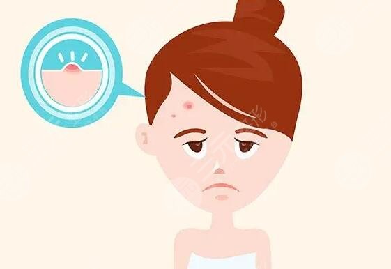 額頭上長痘痘的原因是什么?