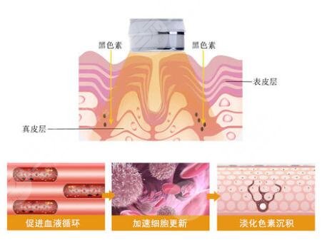 復(fù)合彩光去痘幾次有?