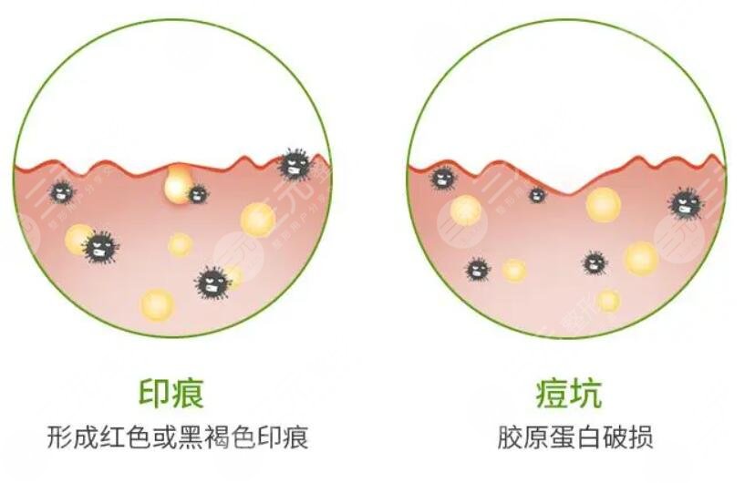 復(fù)合彩光祛痘的案例介紹