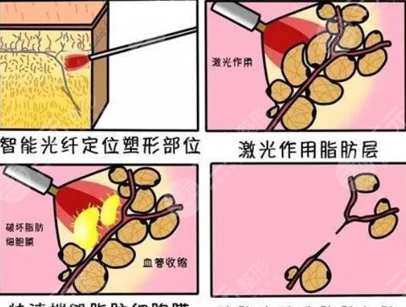 等離子激光溶脂