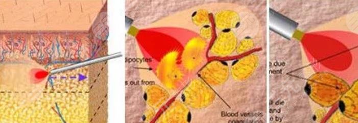 等離子激光溶脂