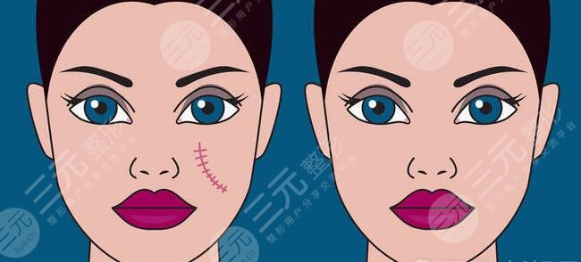 緩解疤痕好的方法有哪些？這3種方法目前來(lái)看果！看看哪種適合你？