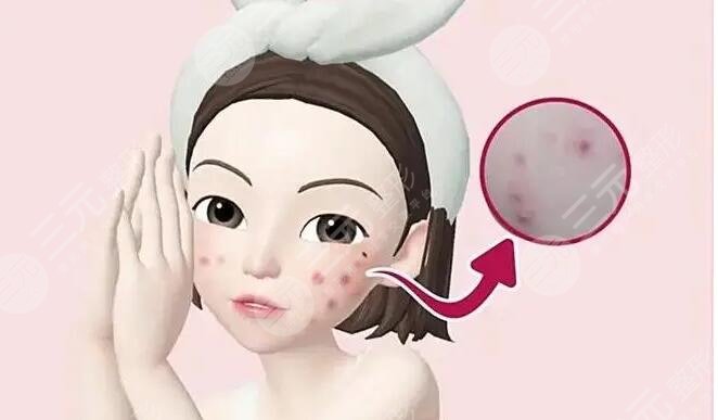 痤瘡疤痕怎么治才能徹底？這幾種有方法網(wǎng)友們親測果，給你更好選擇~