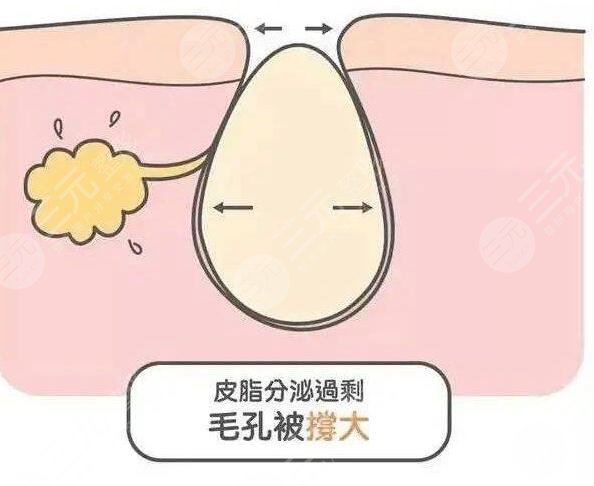什么醫(yī)美項(xiàng)目收縮毛孔果好？近幾年爆款醫(yī)美項(xiàng)目云集，總有一款適合你~