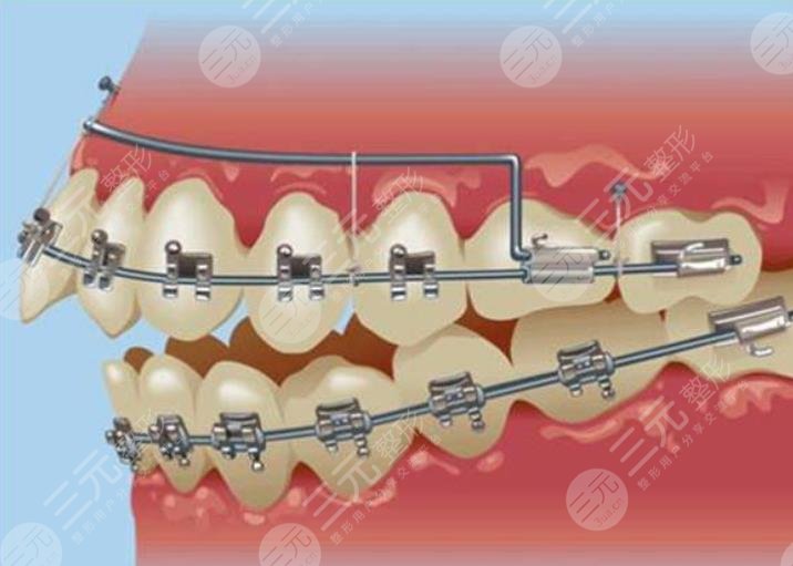 自鎖托槽牙齒矯正