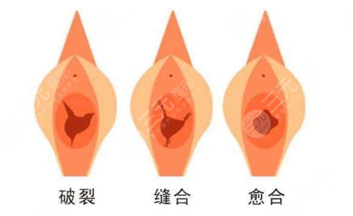 收緊陰道時的注意事項(xiàng)有哪些