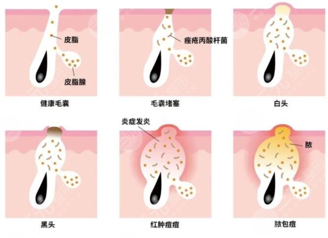 復(fù)合彩光祛痘需要多少錢?