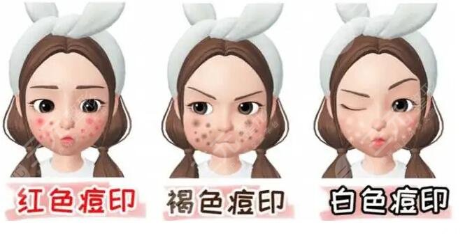 復(fù)合彩光祛痘需要多少錢?