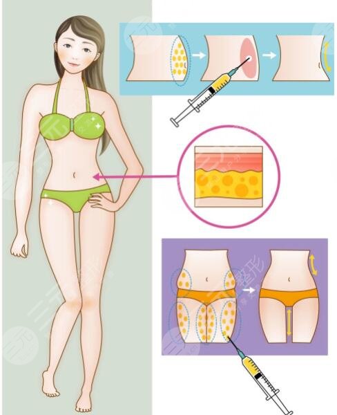 等離子激光溶脂有危害嗎？對身體有傷害嗎？副作用是什么？怎么果？