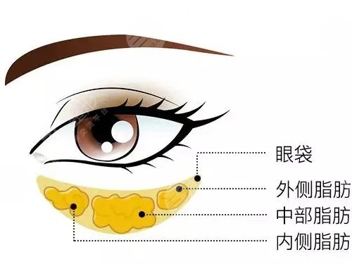 怎么去眼袋快有？