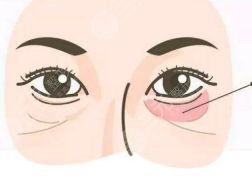 怎么去眼袋快有？
