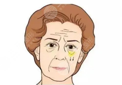 怎么去眼袋快有？