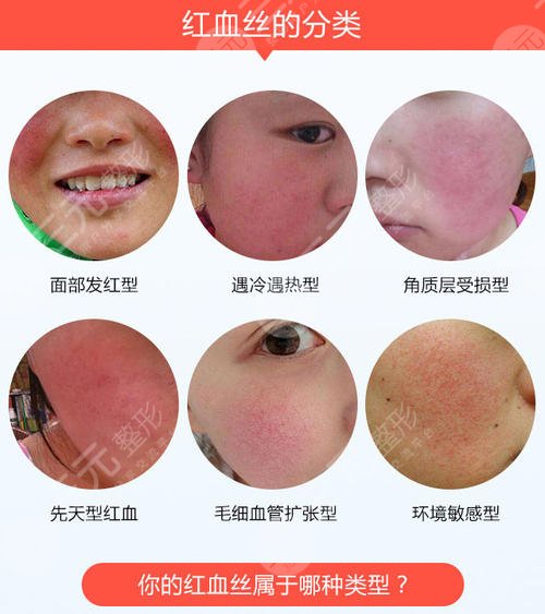 激光去紅血絲后需要注意什么?