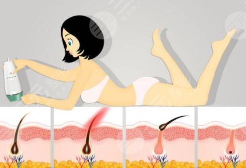 做脫毛的次數(shù)不同價格也就不同