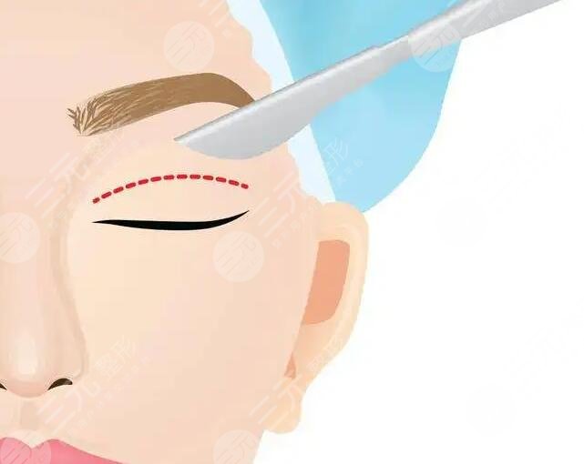 全切雙眼皮手術