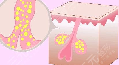 去痘價格大概多少?
