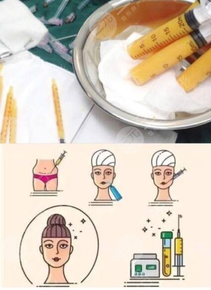 全臉脂肪填充的優(yōu)勢(shì)