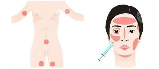 全臉脂肪填充的注意事項(xiàng)