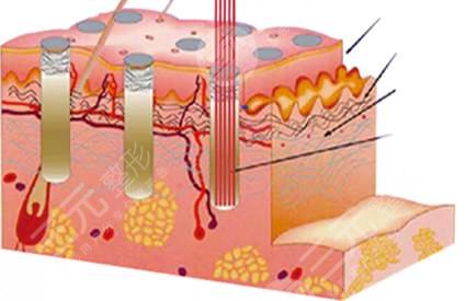 光子去痘有用嗎?原?理介紹