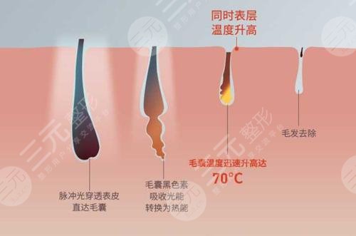 脫毛嫩膚的方法有哪些？