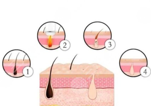 shr冰點(diǎn)脫毛價(jià)格影響因素