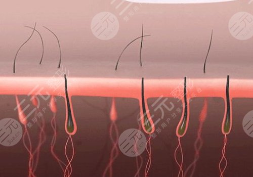 shr冰點(diǎn)脫毛價(jià)格影響因素