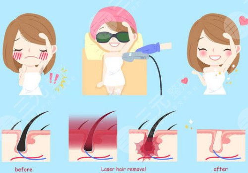 光子脫毛需要幾次能脫干凈?