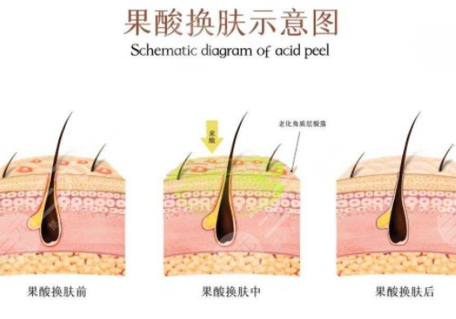 果酸換膚的功有什么?