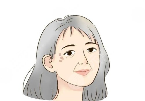 怎樣治老年斑？