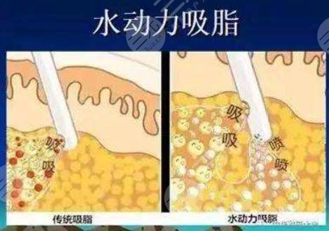 水動力吸脂