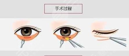 怎么去眼袋快有？
