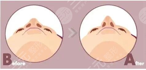 鼻頭鼻翼鼻尖整形恢復(fù)果前后對(duì)比