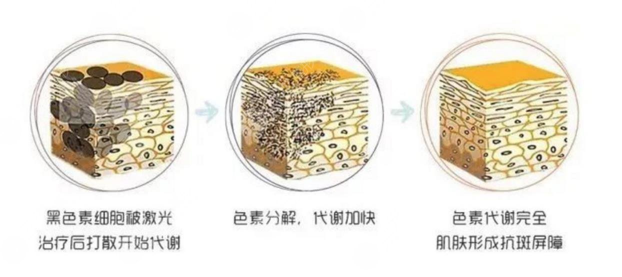 褐青色斑祛除的案例介紹|激光去除經(jīng)歷