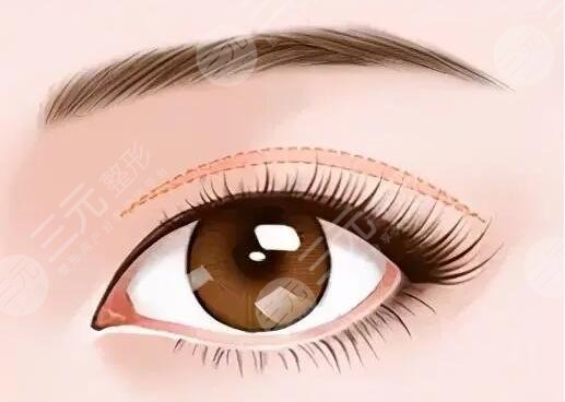 武漢天佑醫(yī)院雙眼皮項(xiàng)目介紹