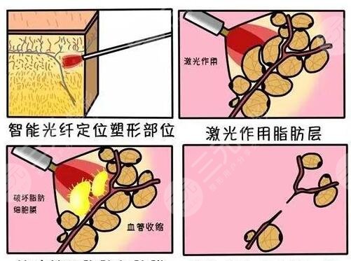 等離子激光溶脂果如何？