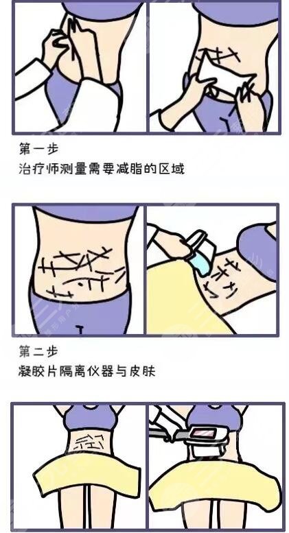 等離子激光溶脂手術(shù)前要注意什么?