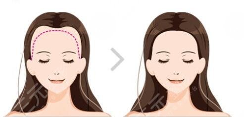 植發(fā)手術(shù)是怎么收費(fèi)的？植發(fā)究竟要準(zhǔn)備多少錢？告訴你真相！