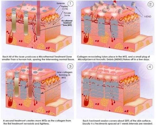 像素激光祛痘坑?果怎么樣?