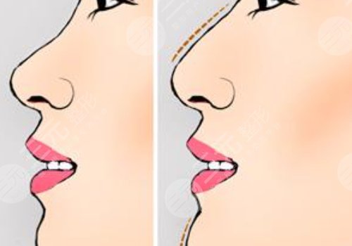 重慶華美做鼻子怎么樣？