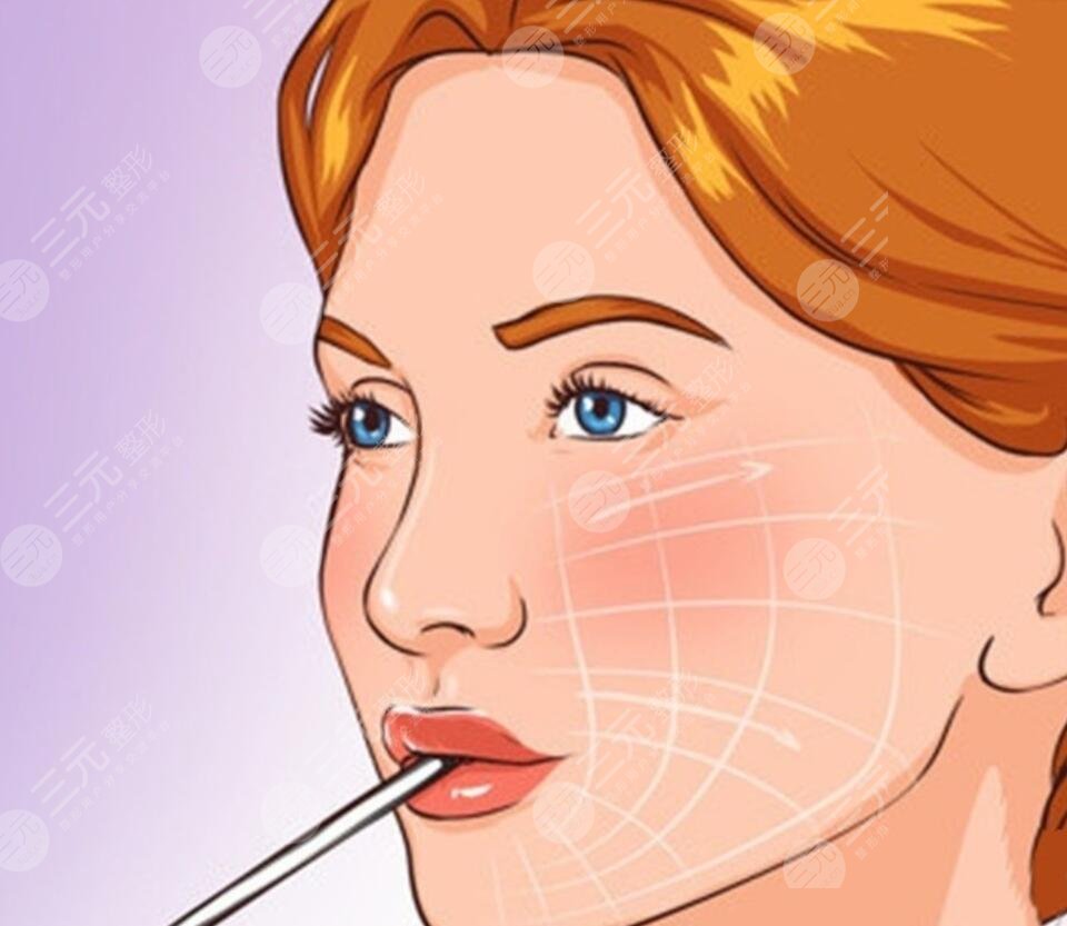 小切口拉皮除皺術(shù)價(jià)格多少2023？術(shù)后多久恢復(fù)？怎么做好護(hù)理工作？